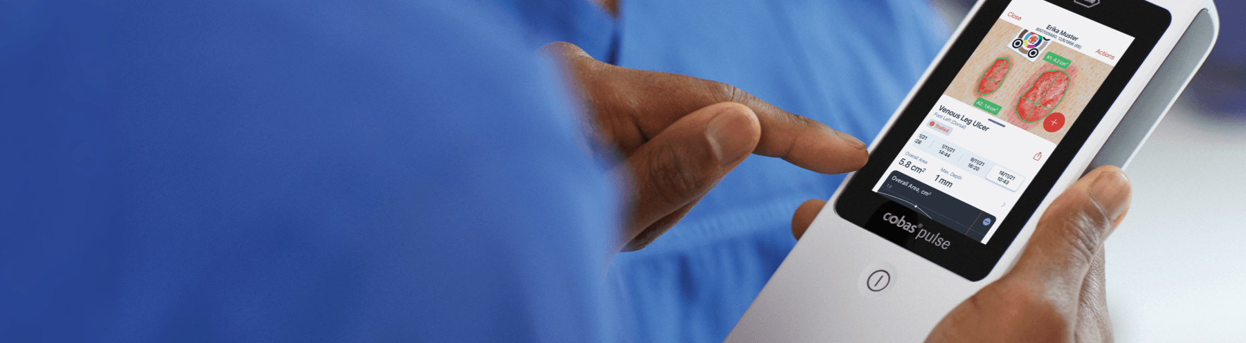 Close-up of a healthcare professional using the cobas® pulse device with imitoWound to assess and measure a venous leg ulcer.