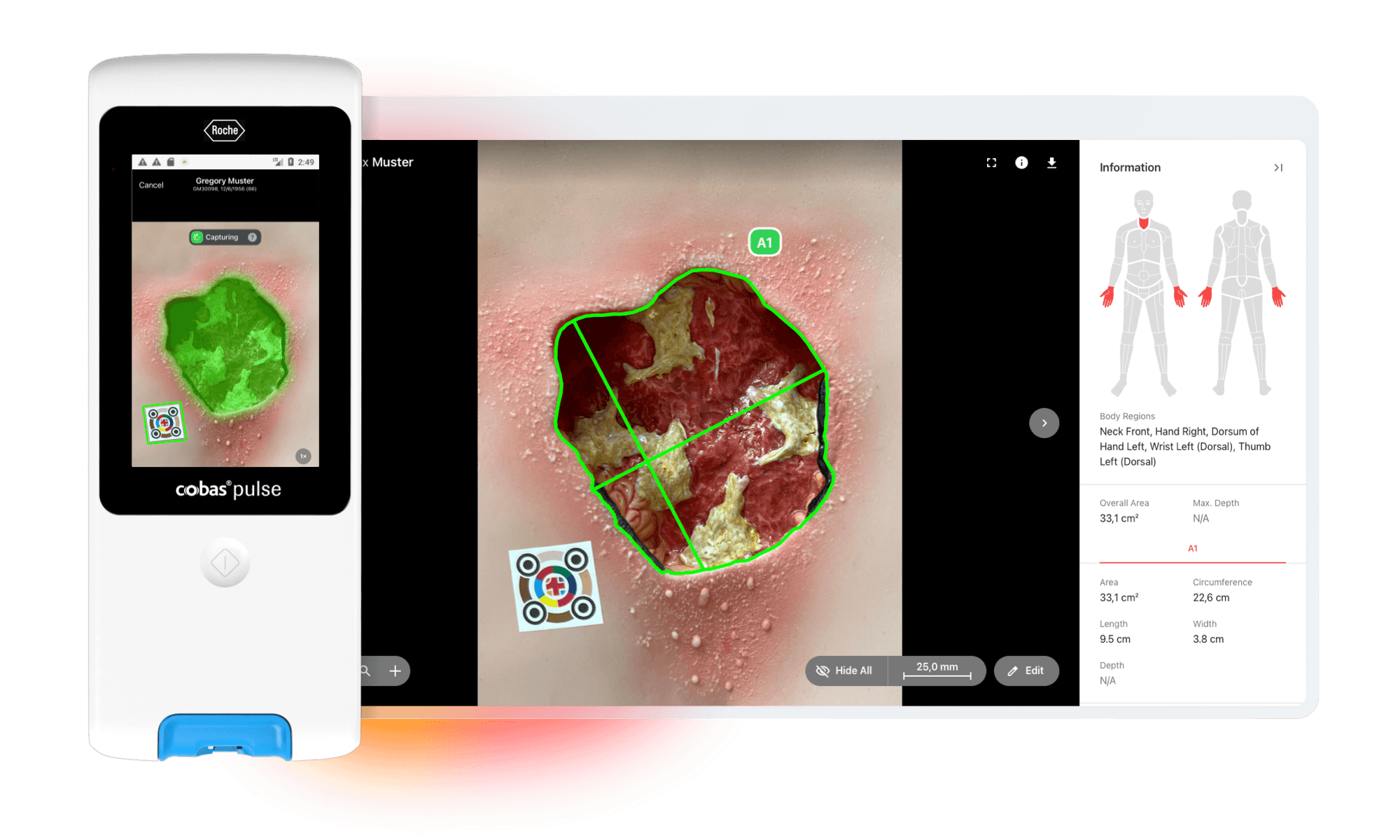 A cobas® pulse device and a tablet displaying the imitoWound app, analyzing a wound with green-marked areas for assessment and measurement.