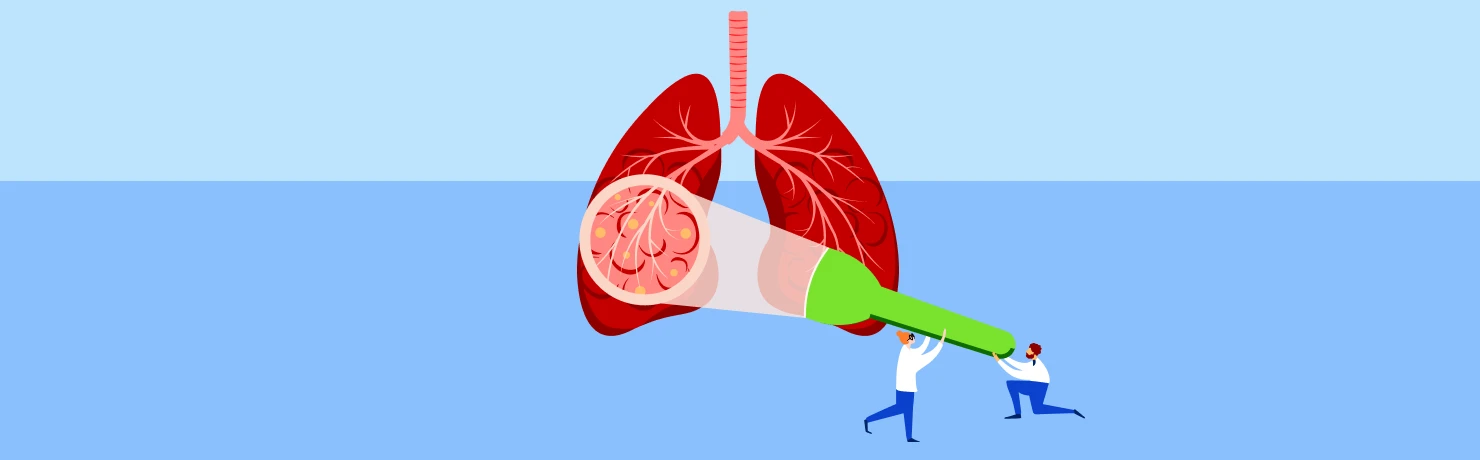 Medical illustration of lung anatomy highlighting cancer detection and screening procedures.