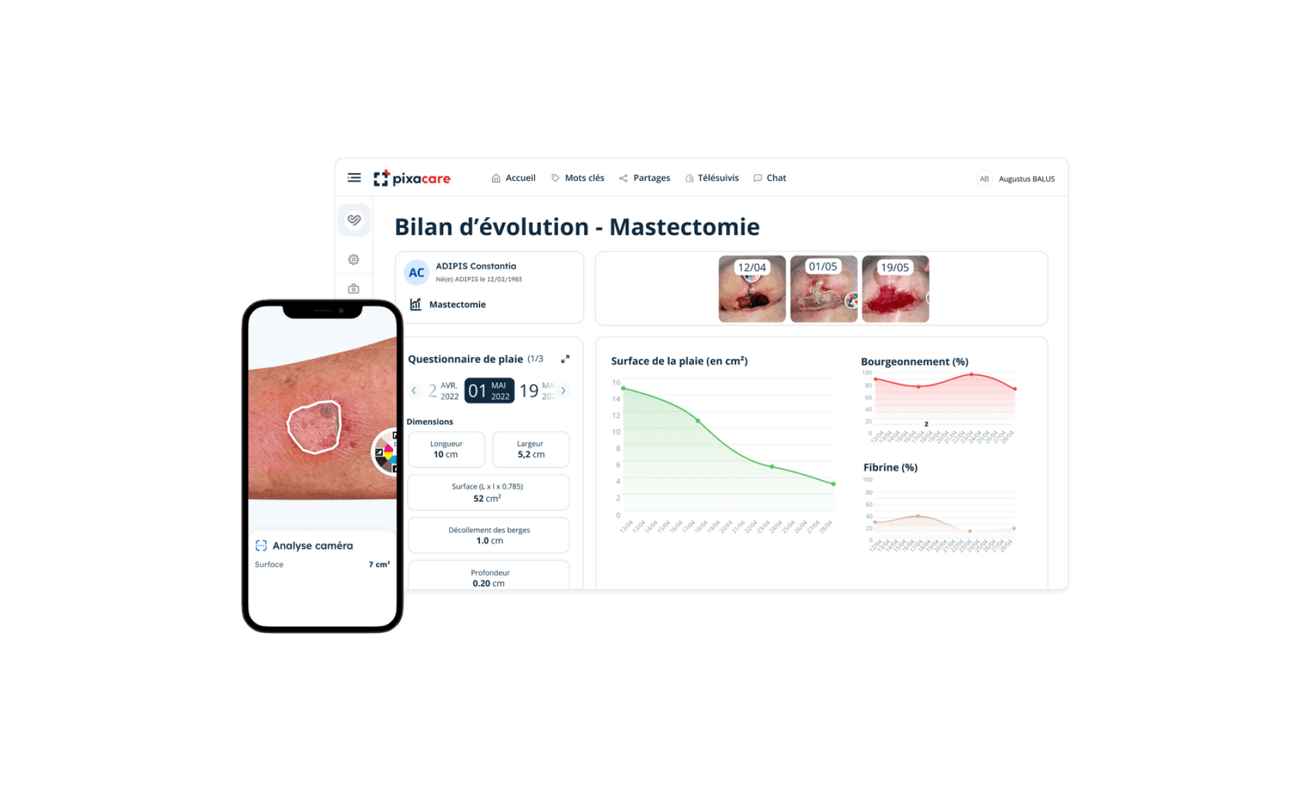 Pixacare web dashboard showing a wound progression report titled 'Bilan d'évolution – Mastectomie' with wound images over time.