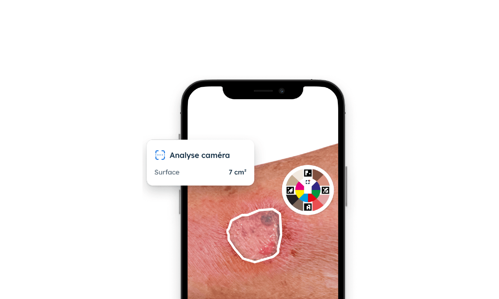 Close-up view of a wound analysis on a mobile phone. A white outline marks the wound area, with a pop-up showing camera-based surface area measurement of 7 cm².