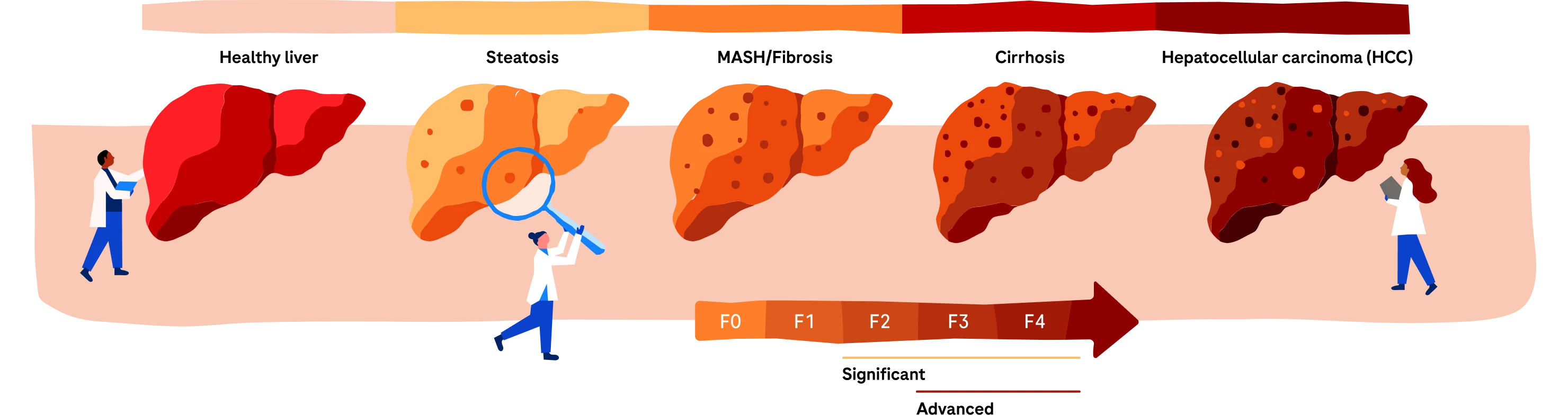 Diagram ilustrating main stages of liver disease progression from normal to cirrhosis